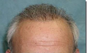 Hair restoration procedure results