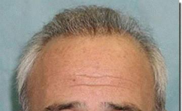 Hair restoration procedure results