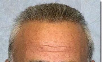 Hair restoration procedure results