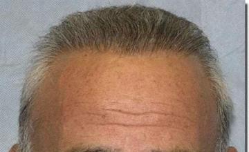Hair restoration procedure results