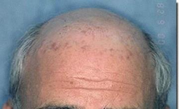 Hair restoration procedure results