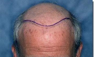 Hair restoration procedure results