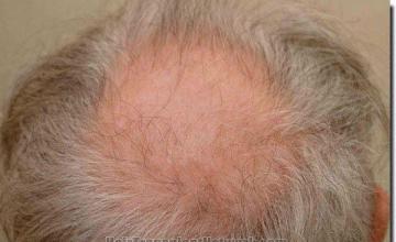 Hair restoration procedure results