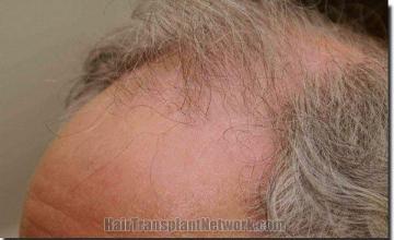 Hair restoration procedure results