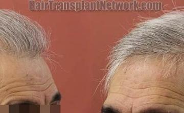 Hair transplantation surgery before and after images