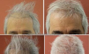 Hair restoration surgery before and after photos