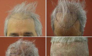 Hair transplantation surgery before and after photos