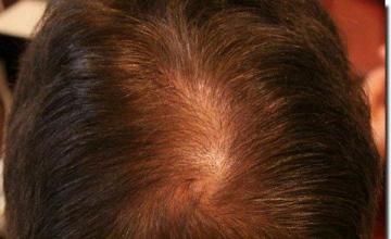 Hair restoration procedure results