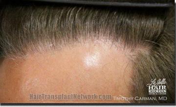 Hair restoration procedure results