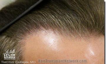 Hair restoration procedure results