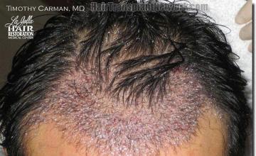 Hair restoration procedure results