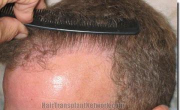 Hair restoration procedure results