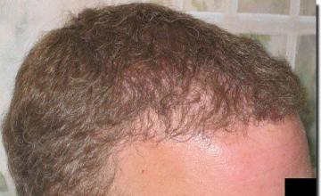 Hair restoration procedure results