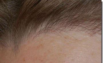 Hair restoration procedure results