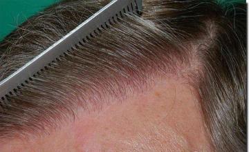 Hair restoration procedure results