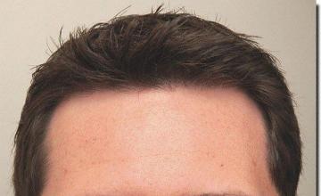 Hair restoration procedure results