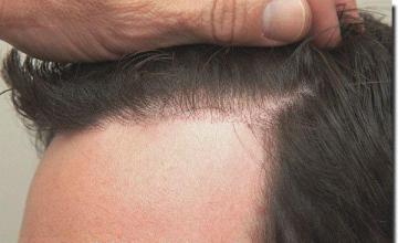 Hair restoration procedure results