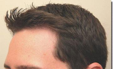 Hair restoration procedure results