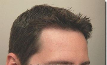 Hair restoration procedure results