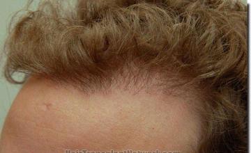 Hair restoration procedure results