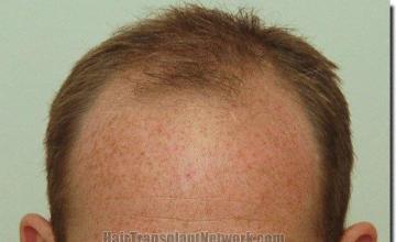 Hair restoration procedure results