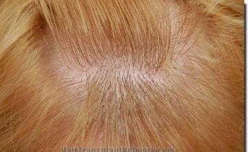 Hair restoration procedure results