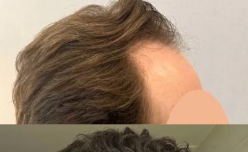 Side Before and After