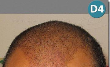 Hair restoration procedure results