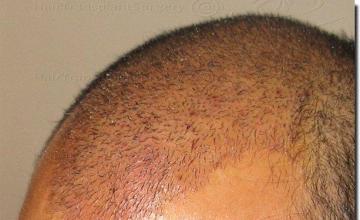 Hair restoration procedure results