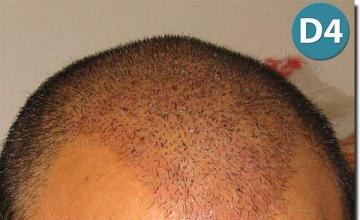 Hair restoration procedure results