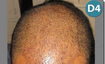 Hair restoration procedure results