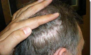 Hair restoration procedure results