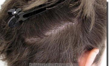 Hair restoration procedure results