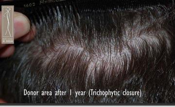 Hair restoration procedure results