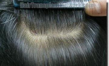 Hair restoration procedure results