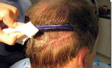 Hair restoration procedure results