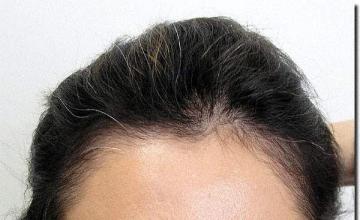 Hair restoration procedure results