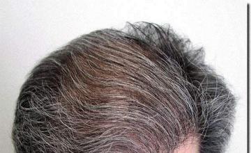 Hair restoration procedure results