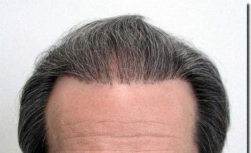 Hair restoration procedure results