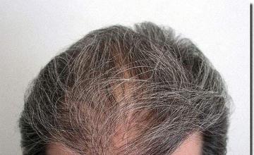 Hair restoration procedure results