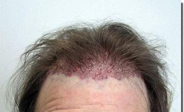 Hair restoration procedure results