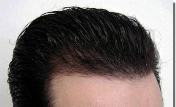 Hair restoration procedure results