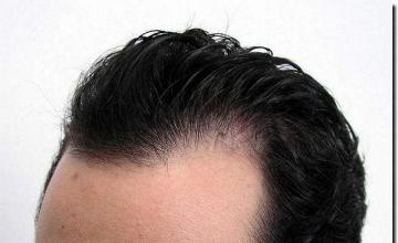 Hair restoration procedure results