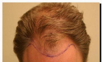 Hair restoration procedure results