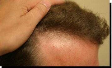 Hair restoration procedure results