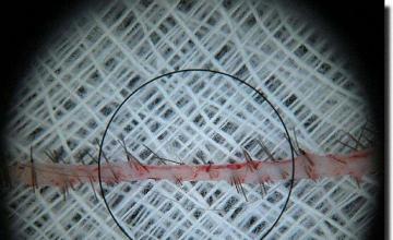 Hair restoration procedure results