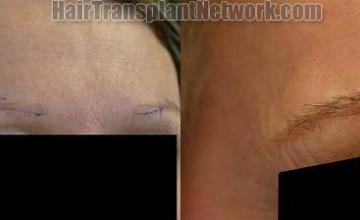 Eyebrow transplant surgery on female patient, shown from the 