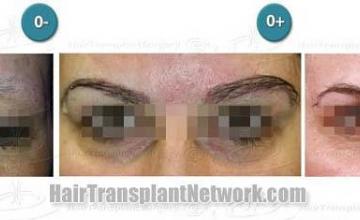 Eyebrow transplantation surgery before and after