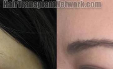 Eyebrow restoration surgery before and after photos