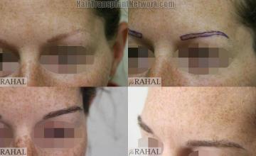 Eyebrow transplantation surgery before and after images